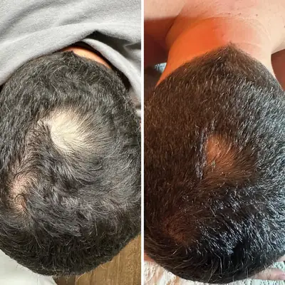 Antes e depois da terapia capilar no topo da cabeça: a falha no cabelo, à esquerda, aparece bem menor à direita
