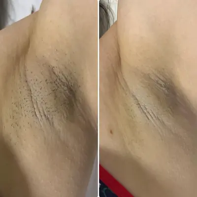Antes e depois da depilação a laser na axila: à esquerda, com pelos; à direita, a pele lisa